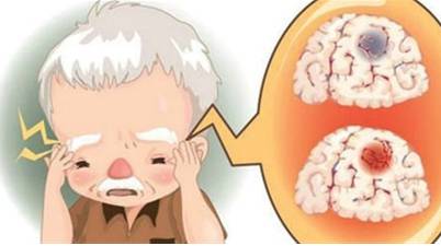 如何护理偏头痛患者 如何护理偏头痛患者